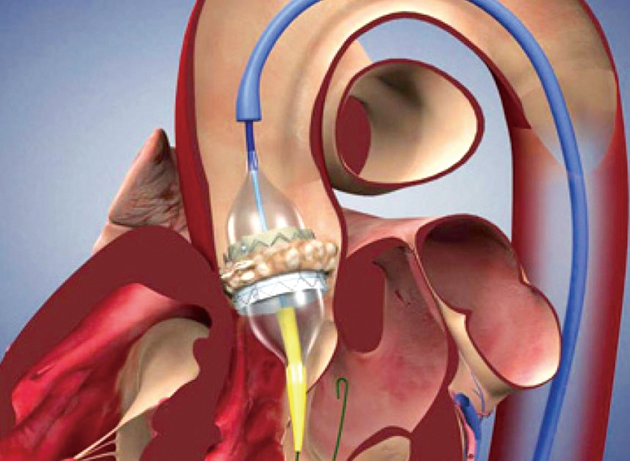 微創式經導管主動脈瓣膜置換手術02
